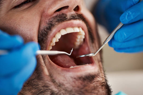 Best Emergency Wisdom Teeth Removal in Kaufman, TX