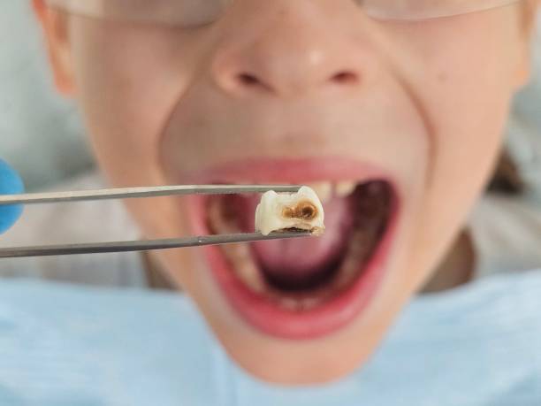 Best Emergency Tooth Extraction in Kaufman, TX