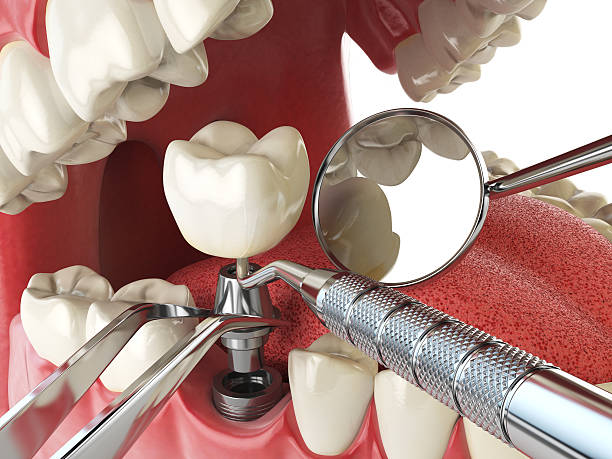 Best Emergency Tooth Extraction in Kaufman, TX